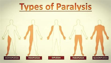 MEDICO LEARNING on Instagram: “Different types of paralysis . . Follow @medico_learning Follow ...