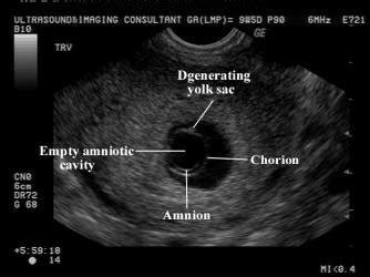 Amniotic Sac Ultrasound