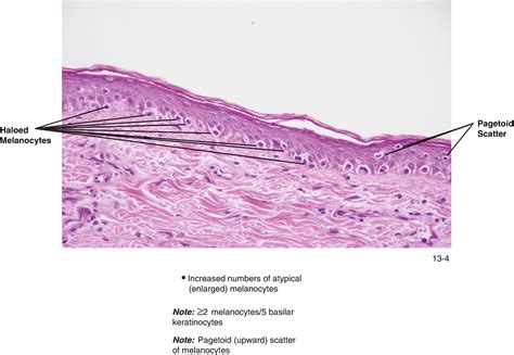 Melanocyte Pathology | SpringerLink