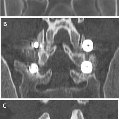 -MRI scan: Left C6 – C7 herniated disc Figure 5 -MRI scan: Left C6 – C7... | Download Scientific ...