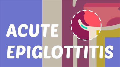What is Acute Epiglottitis? - YouTube