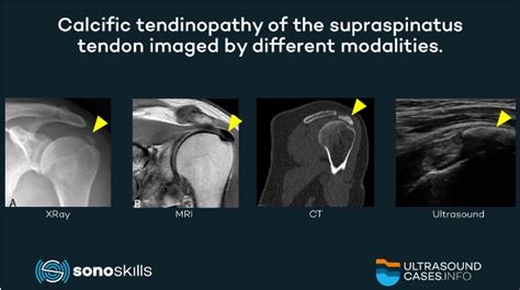 Calcific tendinopathy: a summary from recent literature / SonoSkills