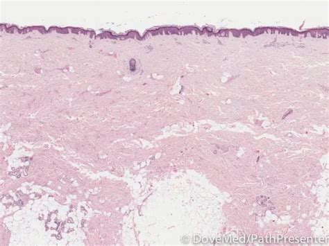 Palmar Fibromatosis - DoveMed