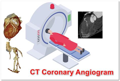 Ct Coronary Angiogram Vs Ct Calcium Score Differences - vrogue.co