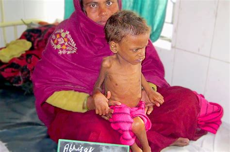 To Save Severe Malnourished Children in Bihar. - GlobalGiving