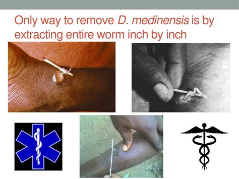 PPT - Dracunculiasis (Guinea Worm Disease) PowerPoint Presentation ...