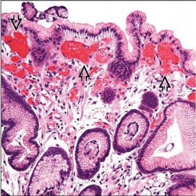 Portal Hypertensive Gastropathy (PHG) | IntechOpen