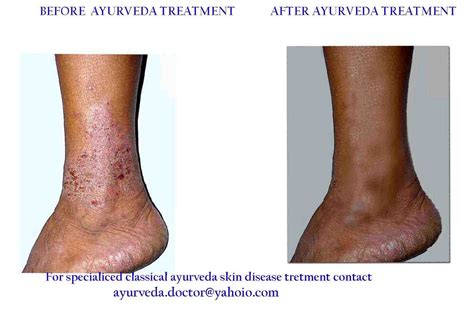 AYURVEDA: ECZEMA PHOTO- before and after My Ayurveda treatment