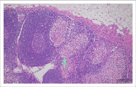 Crohn's Disease Histology