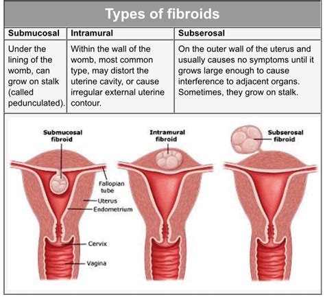 Myomectomy Surgery, Uterine Fibroids Treatment in Thane, Mumbai, India