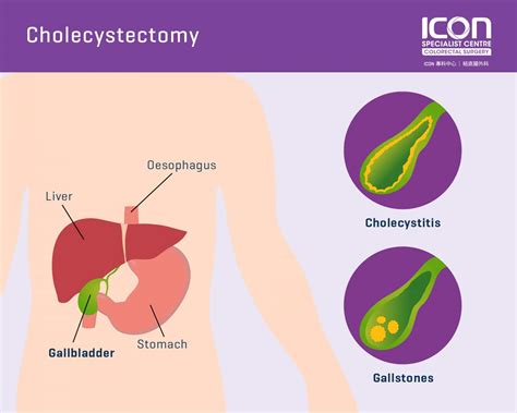 Cholecystectomy — Icon Specialist Centre