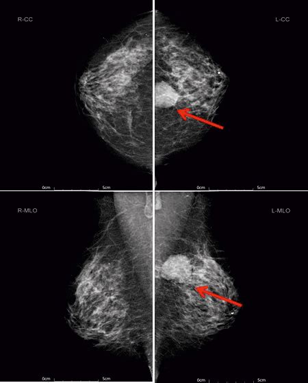 MLO (Mediolateral Oblique) and CC (Craniocaudal) views of the mammogram ...