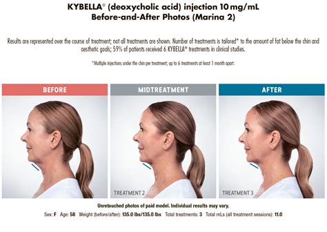 Kybella Double chin treatment - Before & After photos