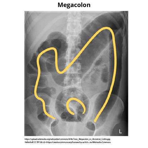 Clinical Pathology Glossary: Megacolon | ditki medical & biological ...