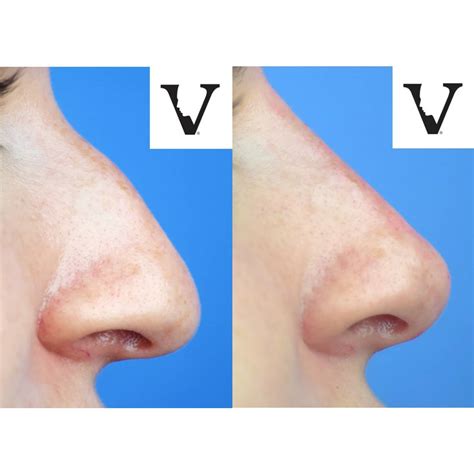 Liquid Nose Job Is The New Procedure After Surgery - Visage Sculpture