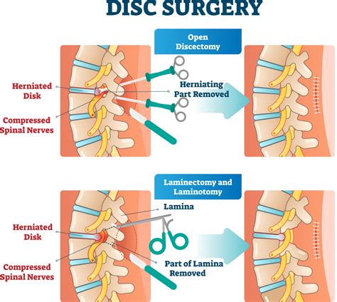 sciatica-surgery-types | Laser Spine Center