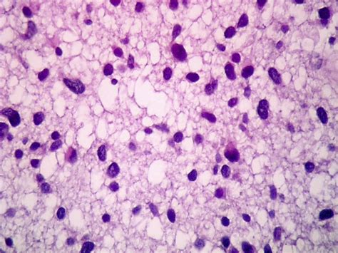 Pathology Outlines - Astrocytoma, IDH mutant