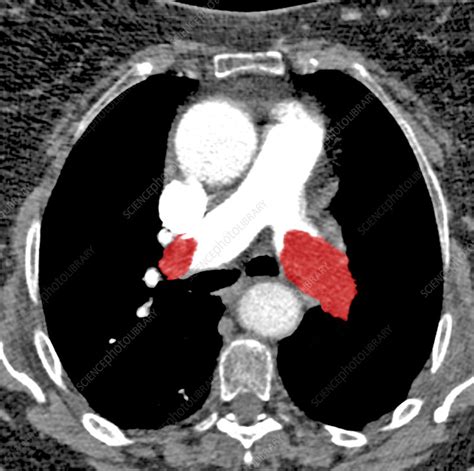 Pulmonary embolism, axial CT scan - Stock Image - C048/6096 - Science Photo Library