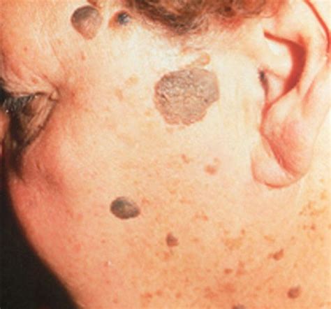 Seborrheic keratosis is a medical term used to define a benign dermatological condition ...