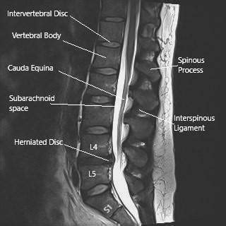 Sciatic Nerve - Anatomy - Complete Orthopedics & Podiatry | Multiple NY Locations