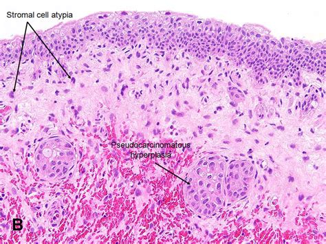 American Urological Association - Radiation Cystitis