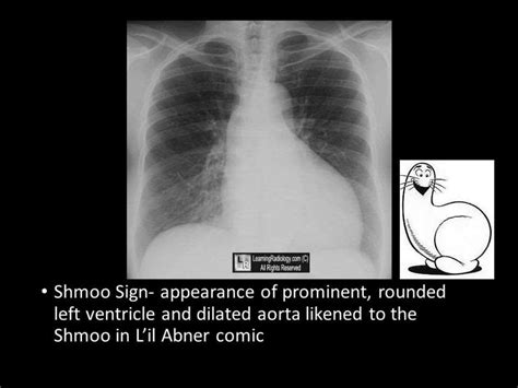 Left ventricular enlargement radiology