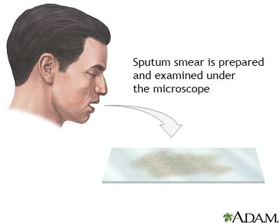 Sputum Smear