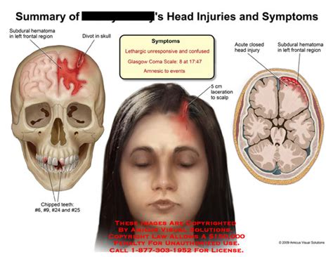 Summary of Head Injuries and Symptoms