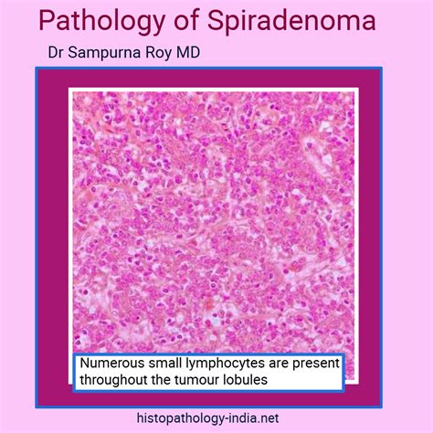 Pathology of Spiradenoma #dermatopathology | Pathology, Derm, Tumor