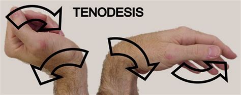 Figure tenodesis2