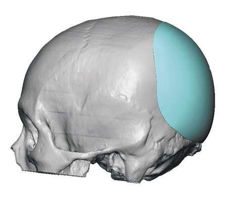 How Can I Treat My Mild Case Of Brachycephaly? - Plastic Surgeon | Dr. Barry L. Eppley, MD