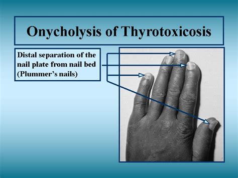 Hypothyroidism — Signs and Symptoms Classic Teaching Symptoms