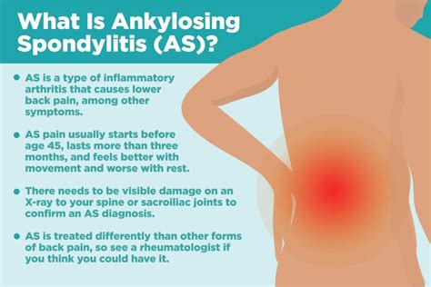 Ankylosing Spondylitis: About, Causes, and Treatments – CreakyJoints