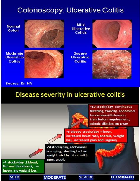 90 best images about Colonoscopy on Pinterest | Health, The cleveland ...