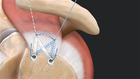 Arthrex - SpeedBridge™ Rotator Cuff Repair Using Tensionable Knotless SwiveLock® Anchors