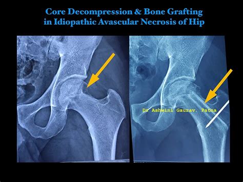Avascular Necrosis (AVN) Treatment & Management - Dr. Ashwini Gaurav