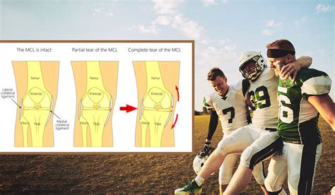 How to Heal an MCL Tear - Comprehensive Orthopaedics