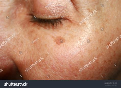 Brown Spots Under Eye Pigmentation On Stock Photo (Edit Now) 546164434