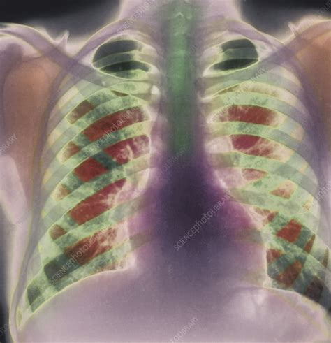 Chronic bronchitis, X-ray - Stock Image - M120/0111 - Science Photo Library