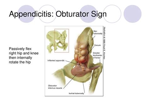 PPT - Acute Abdominal Pain PowerPoint Presentation, free download - ID:6592645