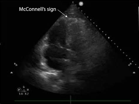 Lung ultrasound for pulmonary embolism - Critical Care Sonography