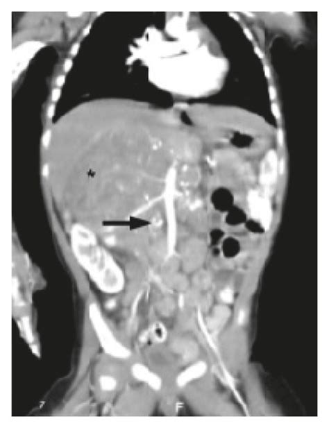 Initial axial T2-weighted MRI revealed the soft tissue lesion with a ...