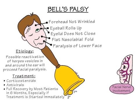 Nursing Mnemonics: Bells Palsy - StudyPK | Nursing mnemonics, Nursing ...