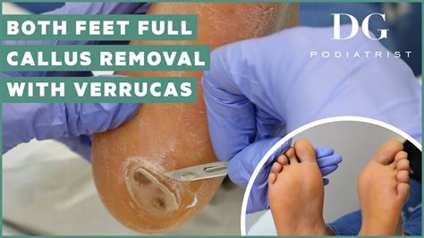 Verruca Plantaris Treatment