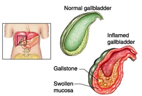 Gallbladder Sludge - Treatment, Symptoms, Removal, Diet, Causes | HubPages