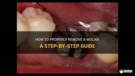 How To Properly Remove A Molar: A Step-By-Step Guide | MedShun