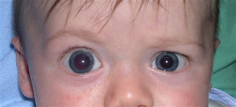 Primary congenital glaucoma: for patients - Gene Vision