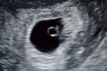 Early ultrasound - 5 weeks 6 days | BabyCenter