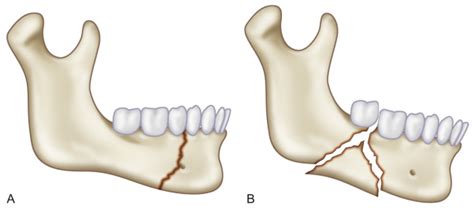 Mandible Fractures | Plastic Surgery Key