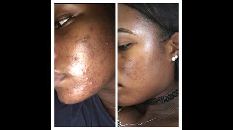 Doxycycline: Journey to Clear Skin (GRAPHIC PHOTOS)// LIV KNIGHTLY - YouTube